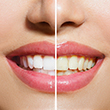 Cosmetic  Whitening T Spa teeth whitening special image